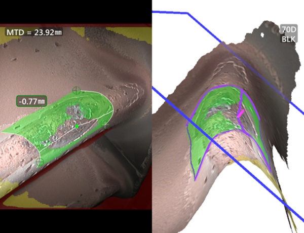 使用三維測量工業內窺鏡測量凹坑深度